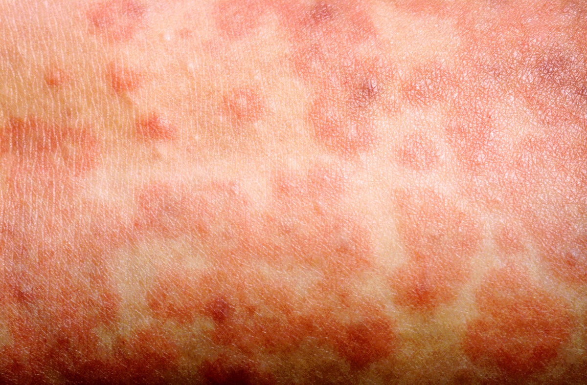 Measles rash on Caucasian skin