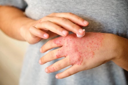 Close up view of hands as they apply a moisturizing cream to the eczema affecting the back of the left hand.