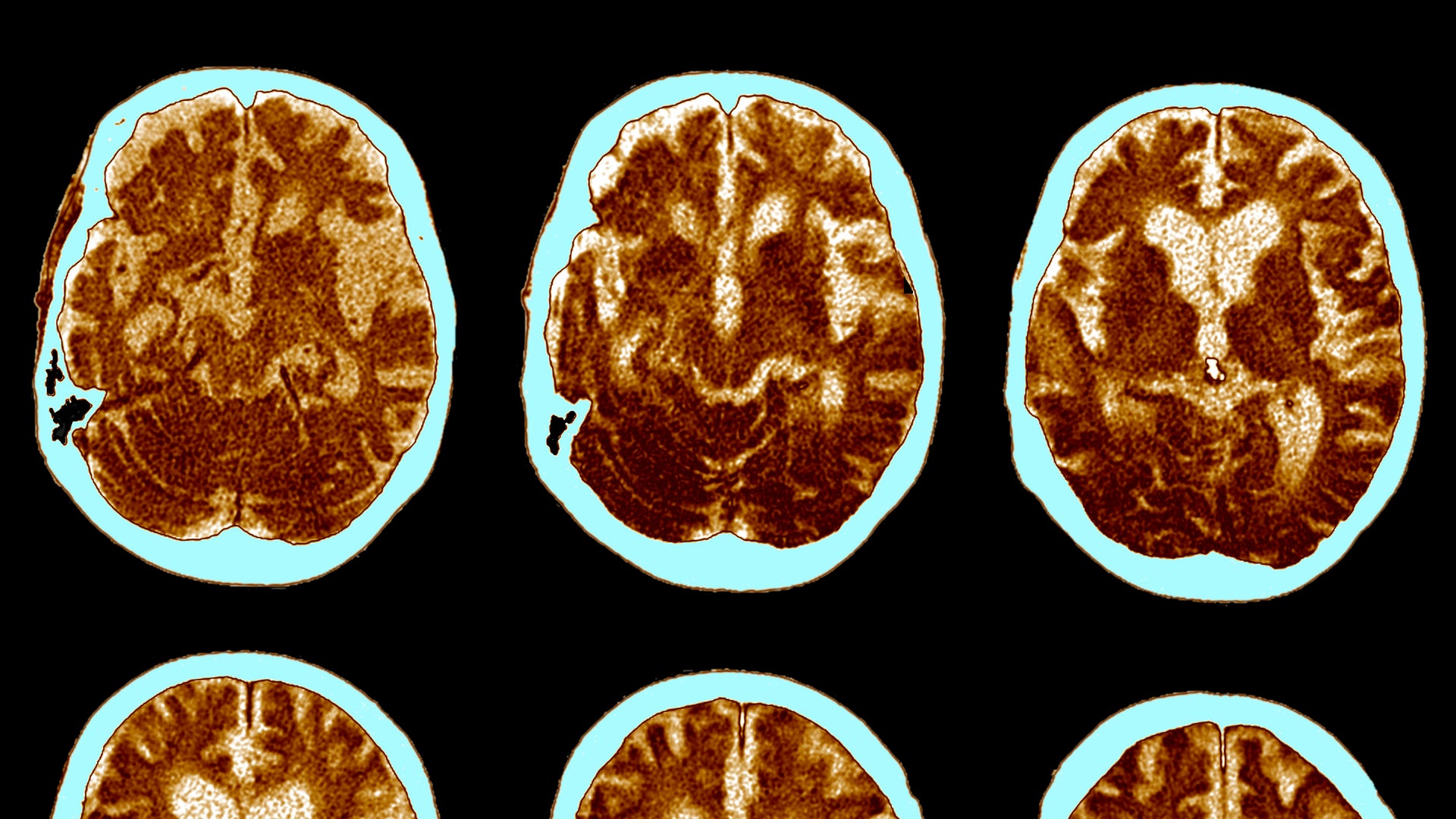 glp-1 alzheimer's clinical trials GLP-1 Pill Fails to Slow Alzheimer's Progression in Clinical Trial