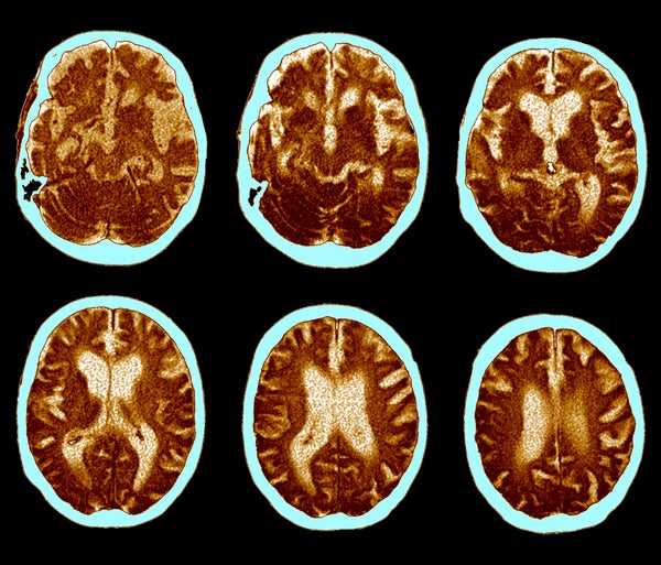 Series of coloured CT scans of an axial section through the head. Brain shrinkage is visible.