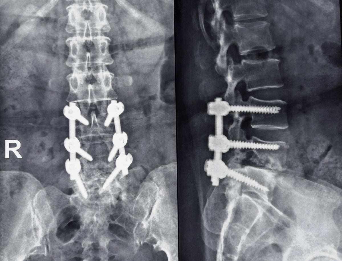 X-ray of the human Lumbar side by side with screws.