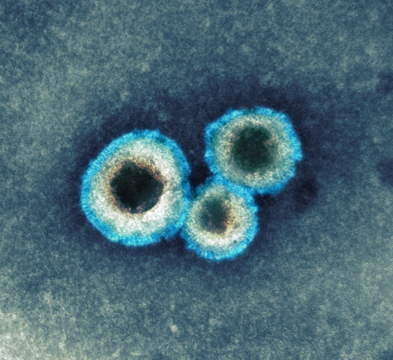 What Is Human Metapneumovirus, and Why Are Cases Rising in China ...