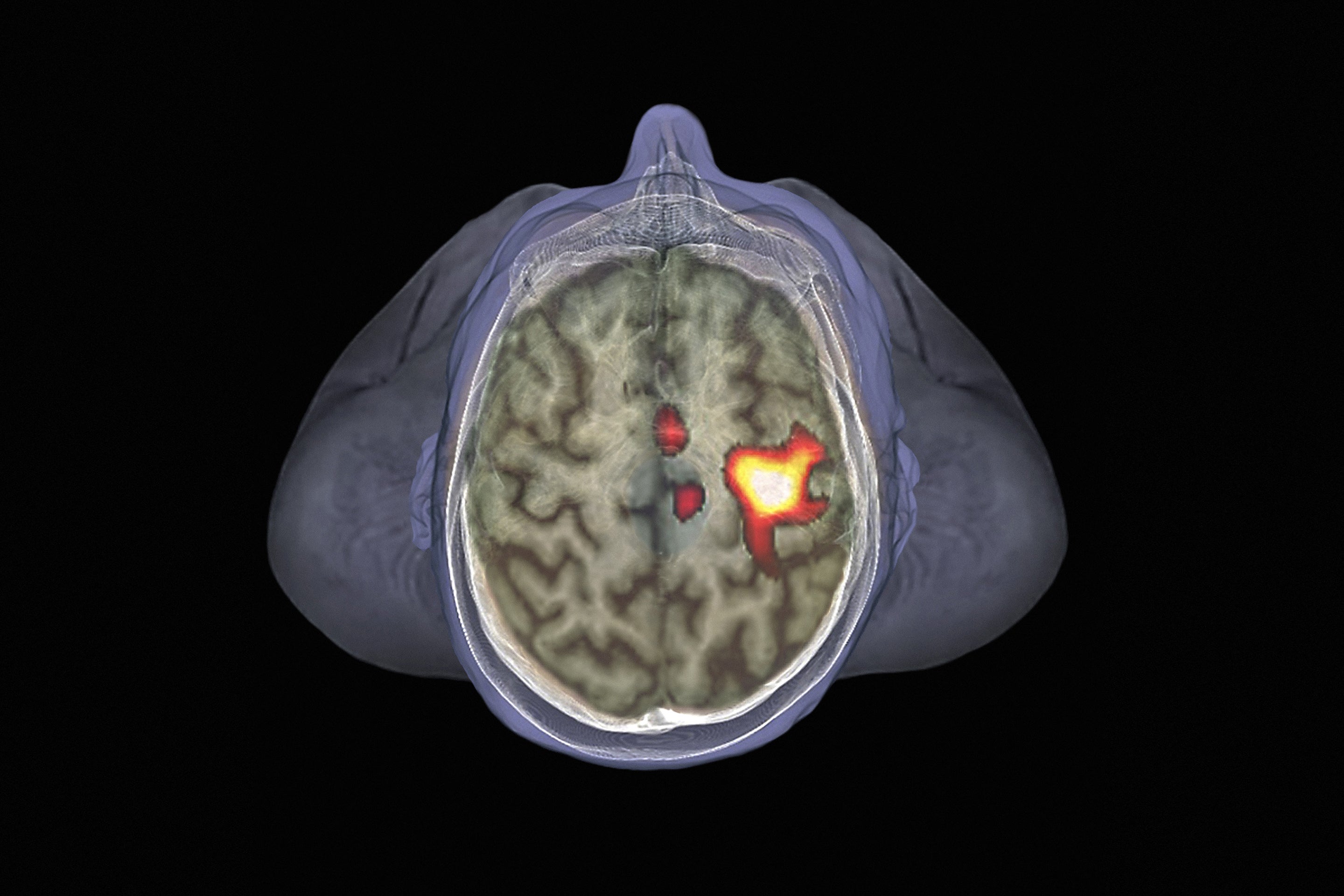 FMRI scan of a healthy brain. A yellow-orange area of the right hemisphere of the brain shows increased activity in part of the motor cortex