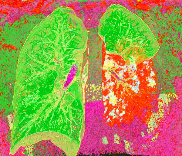 Pneumonia, CT scan