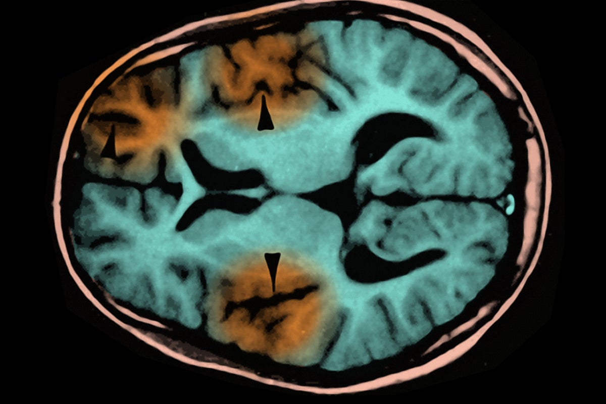 Measles in the Brain Can Kill Years after Infection, Child’s Death Shows