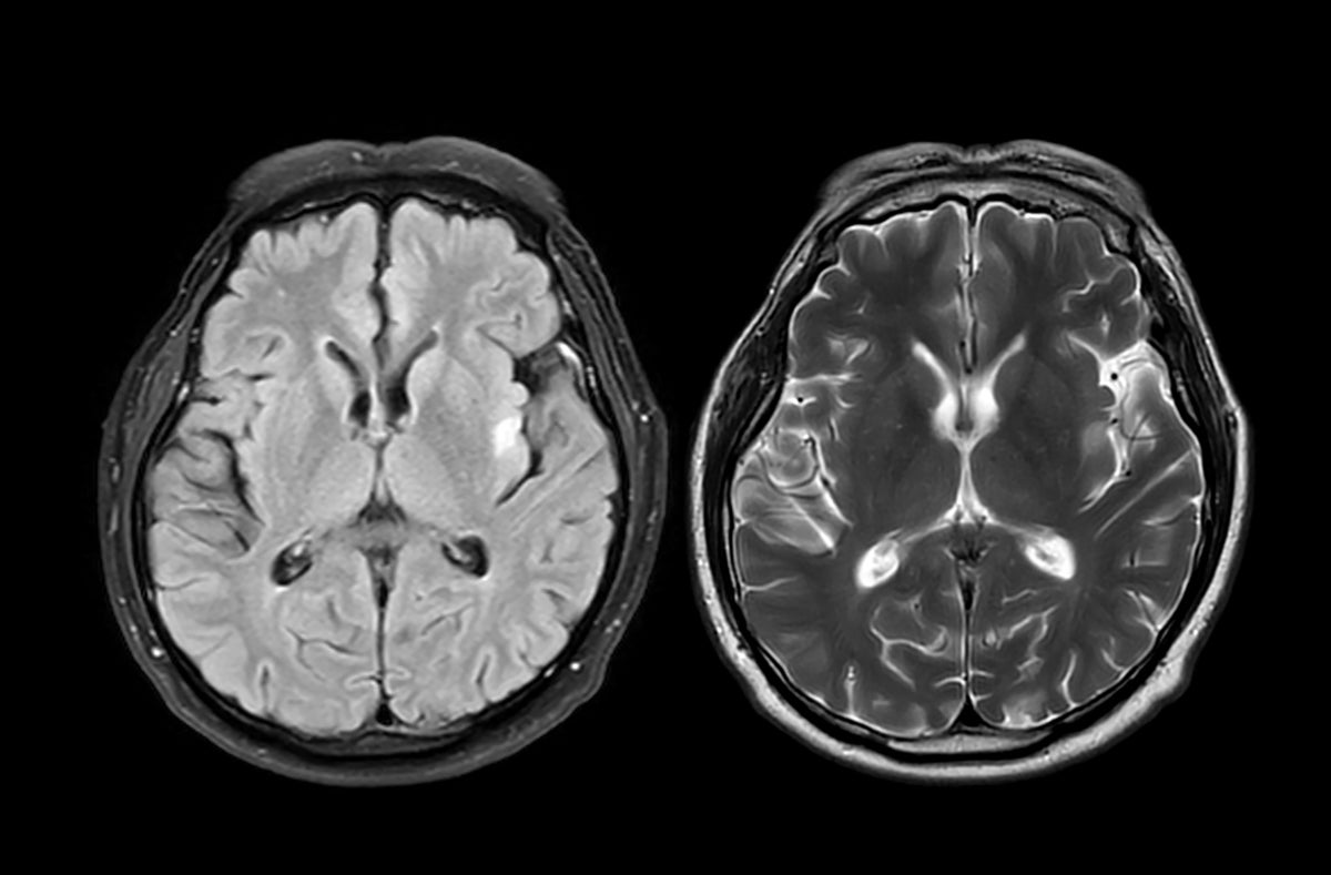 The COVID Pandemic May Have Aged Your BrainEven If You Never Got Sick