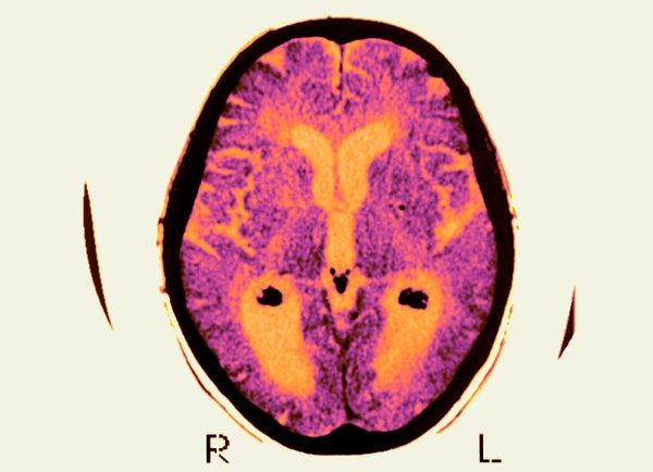 Brain MRI - Axial Cut Away View. Median Portion Of Dilated Third Ventricle. Symettrical Dilation Of Intersections, Whereas The Cortical Horns Are Normal In Size.