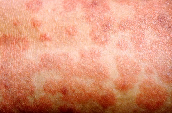 麻疹引起的皮疹导致大红色贴边的图片
