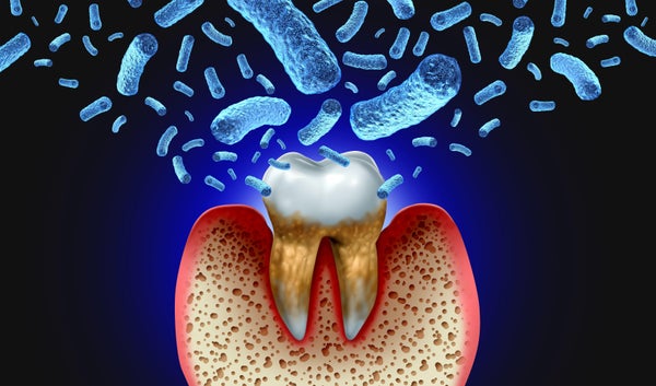 Illustration of a molar tooth with periodontitis.