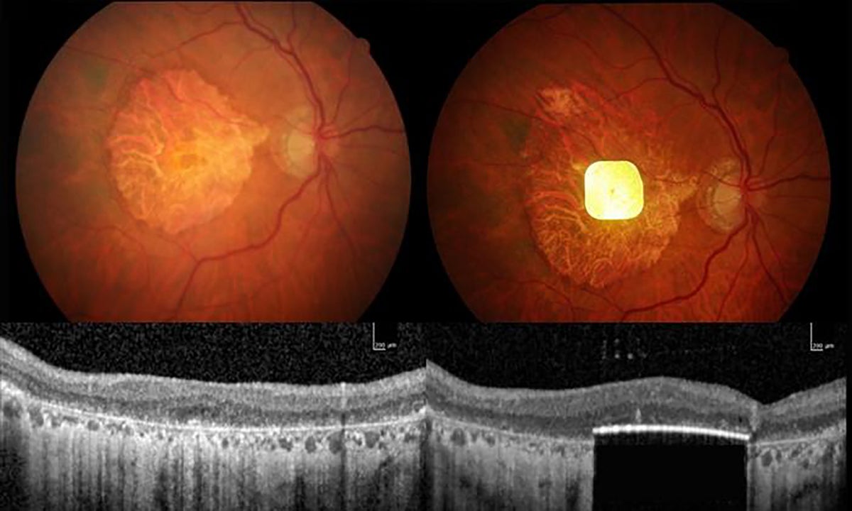 Composite image of scans of the chip in a patient's eye