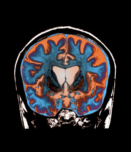 Brain in Huntington's disease