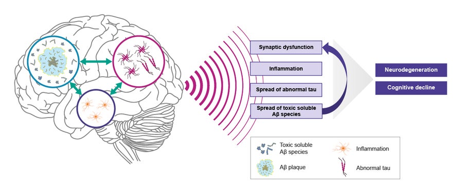 Illustration depicting the proposed mechanisms of smoldering Alzheimer’s disease. 