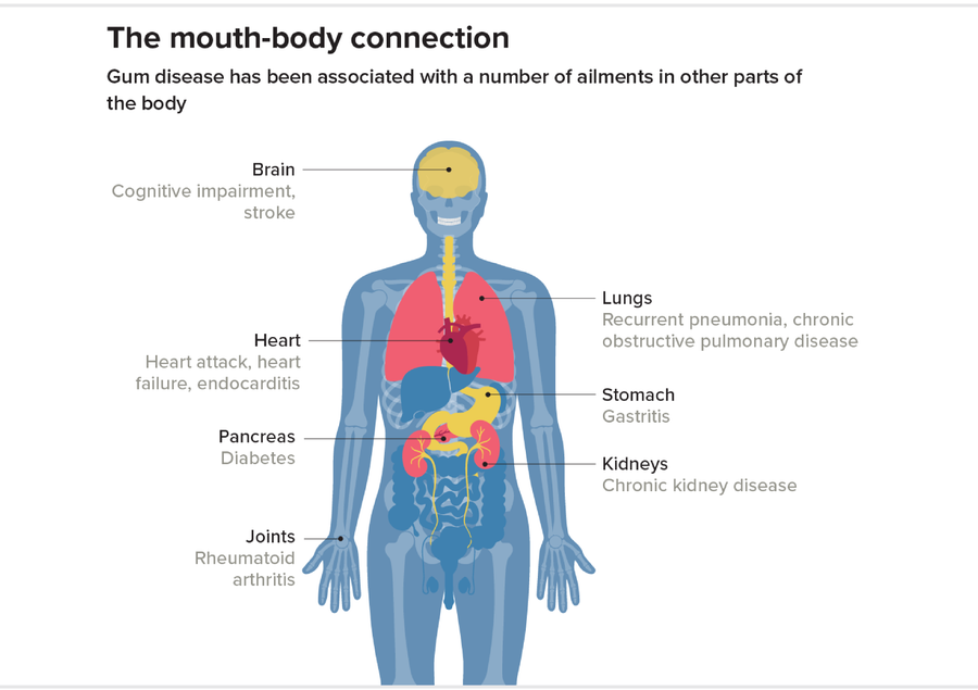 Diagram of a body highlighting the various organs affected by poor dental health.