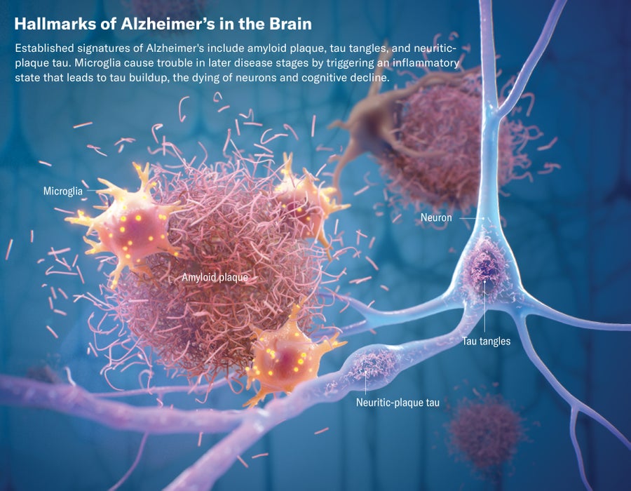 Graphic image depicting hallmarks of Alzheimer's in the brain through different brain anatomy.  