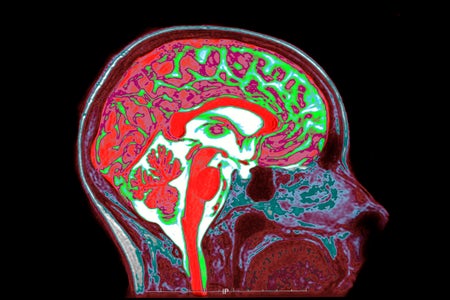 Brain Mri sagittal view