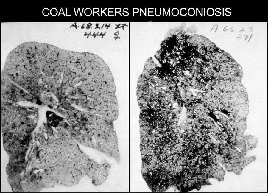This occupational health image shows the lungs of a coal worker with Pneumoconiosis, or Black Lung Disease, 1973