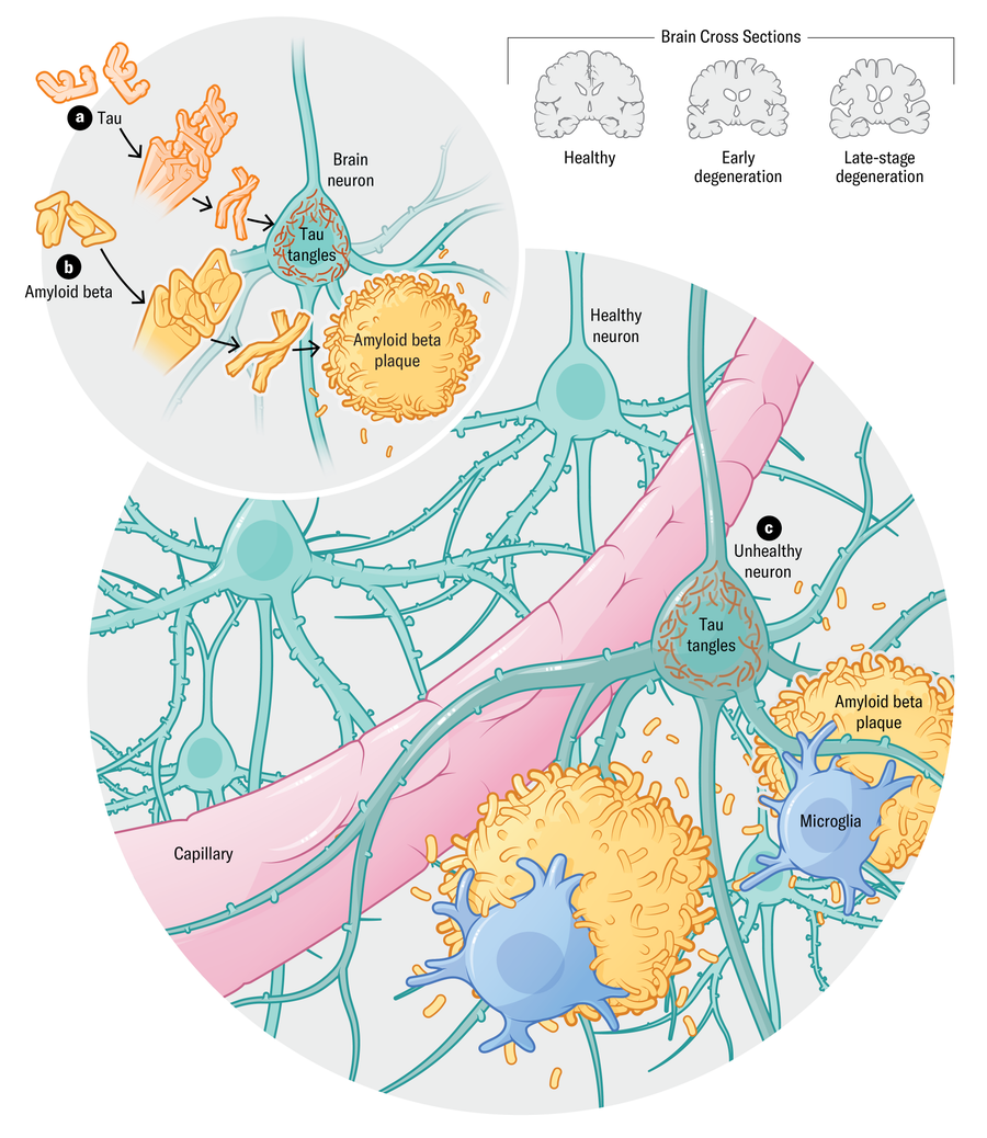 A ilustração mostra uma vista celular dentro do cérebro. A primeira vinheta mostra a tau e o beta amilóide acumulando -se dentro e ao redor dos neurônios. A segunda vinheta mostra o impacto desses emaranhados e placas - resultando em neurônios não saudáveis.