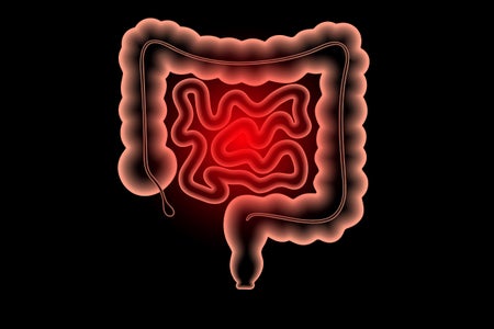 Illustration of Inflammation of the the human intestine.