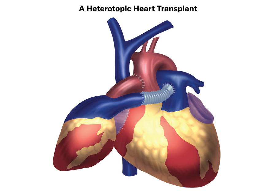 Illustration represents a heterotopic heart transplant, with two hearts stitched together.