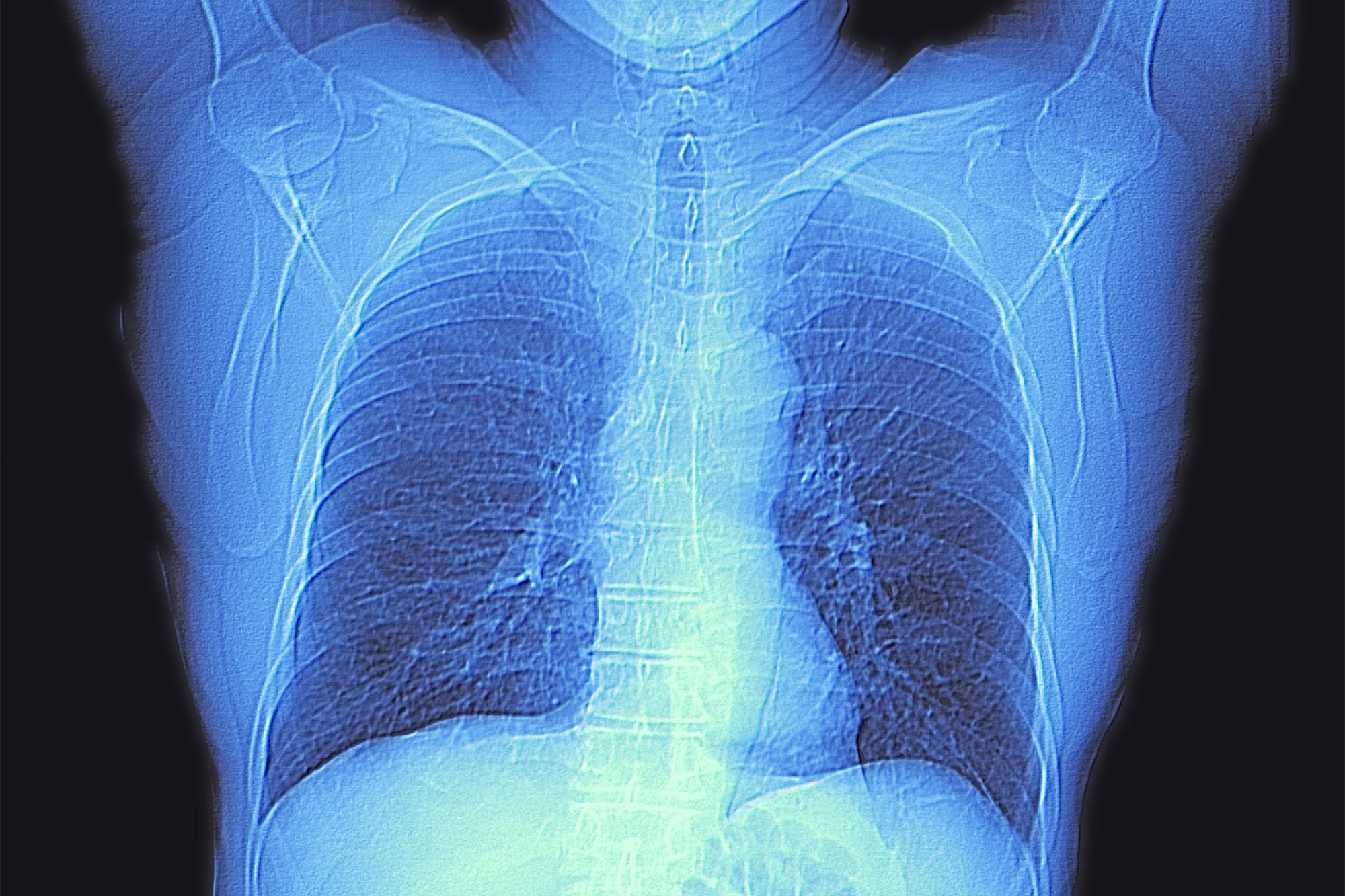 Computed tomography (CT) scan of the chest of an healthy adult, showing normal lungs