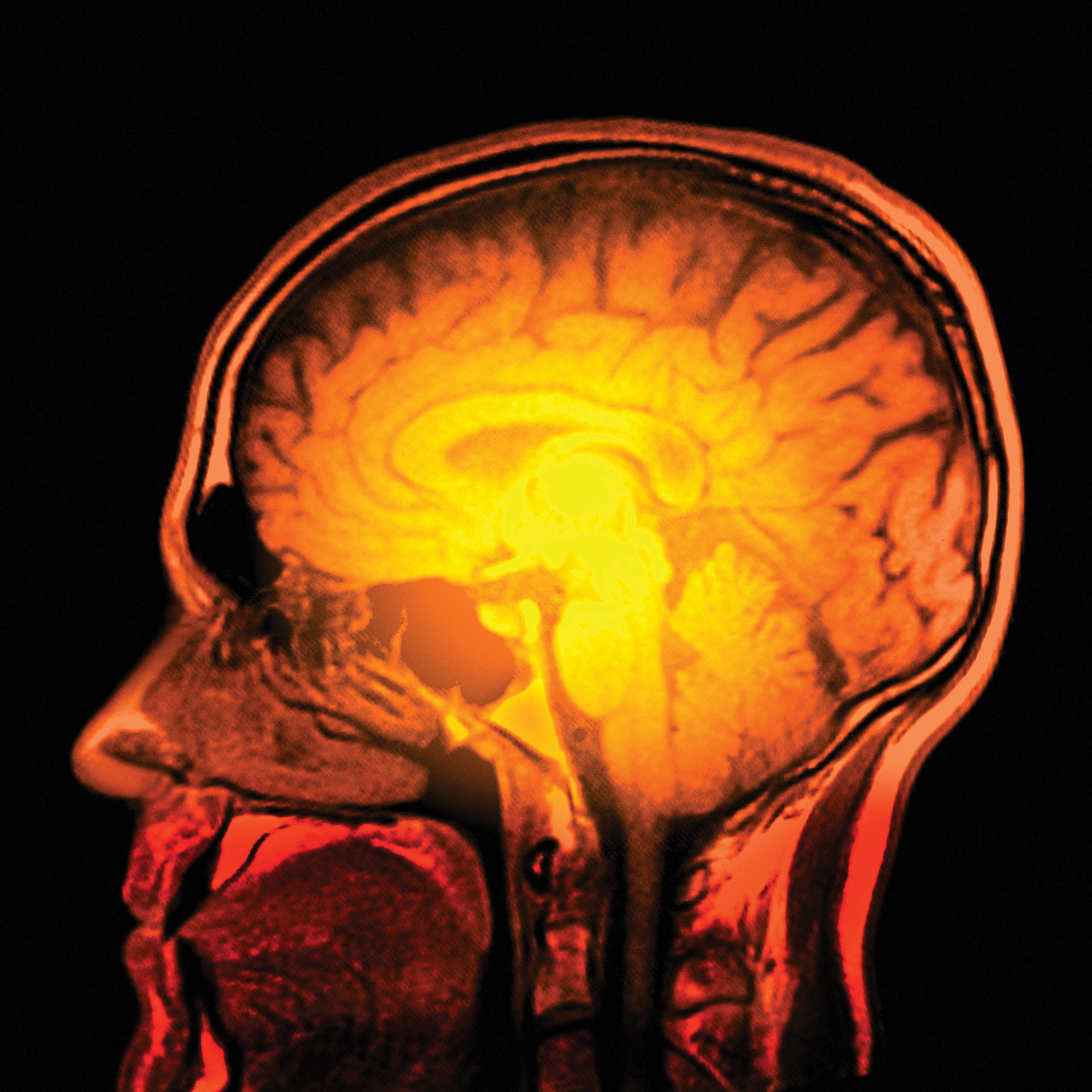 Yellow-toned MRI scan of a human head, showing the brain.