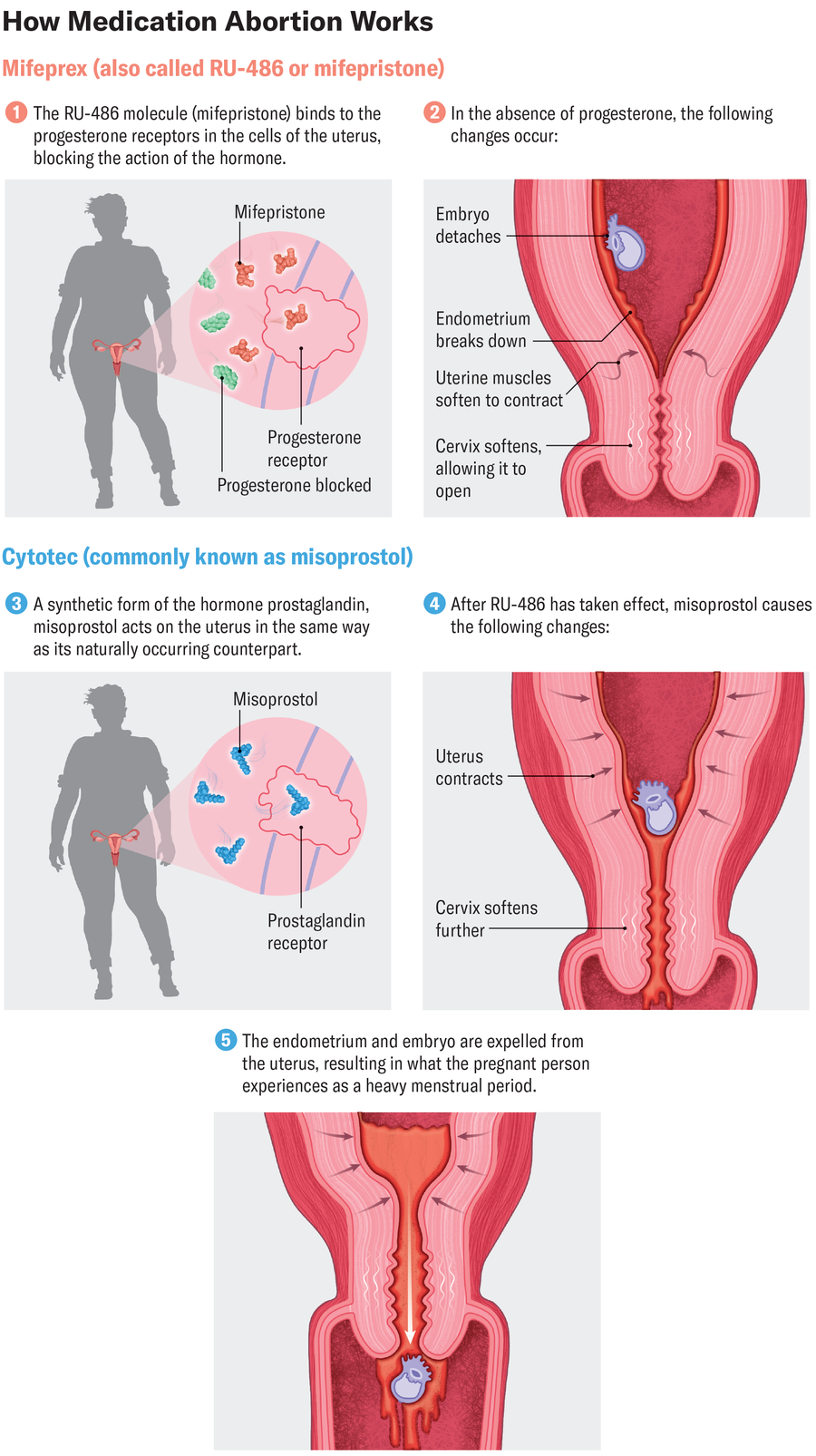 Graphic shows how mifepristone and misoprostol act on the uterus and cervix to expel the embryo and endometrium.