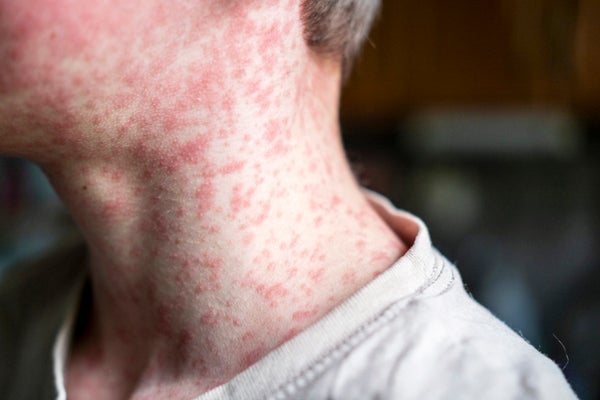 measles rash