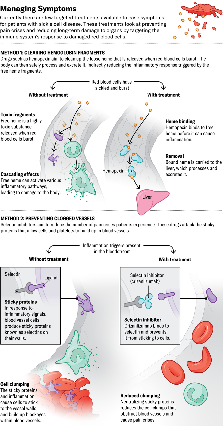 Currently there are few targeted treatments available to ease symptoms for patients with sickle cell disease. Illustration shows two approaches that aim to prevent pain crises and reduce long-term damage to organs by targeting the immune system’s response to damaged red blood cells. Strategies include clearing hemoglobin fragments, and preventing clogged vessels.