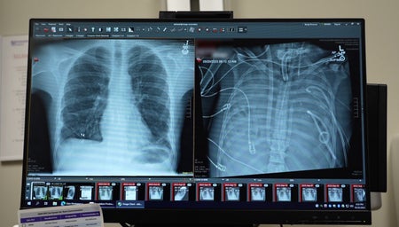 Side by side x-rays. The image on the right is foggy white