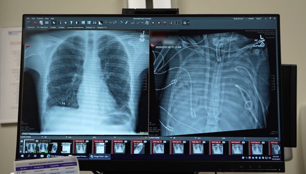 Side by side x-rays. The image on the right is foggy white