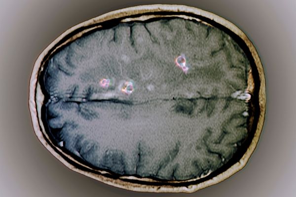 How Do People Get Parasitic Brain Worms Like The One RFK Jr Had How Do People Get Parasitic Brain Worms Like The One RFK Jr Had