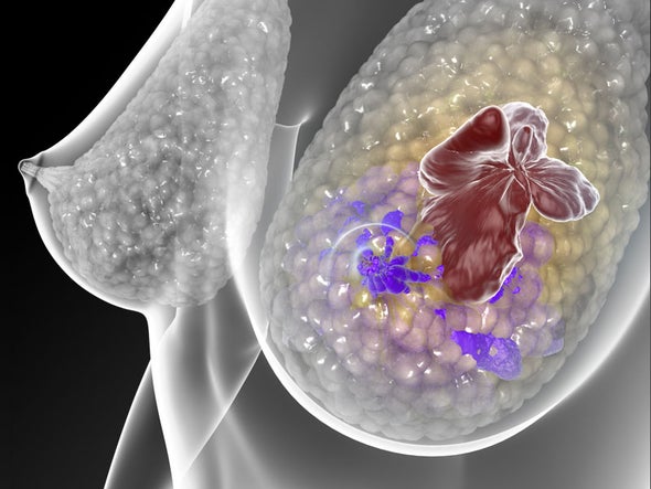 Examen de sangre podría predecir recaídas de cáncer de mama