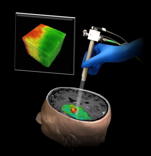 Nueva tecnología de imágenes en 3D promete facilitar las neurocirugías