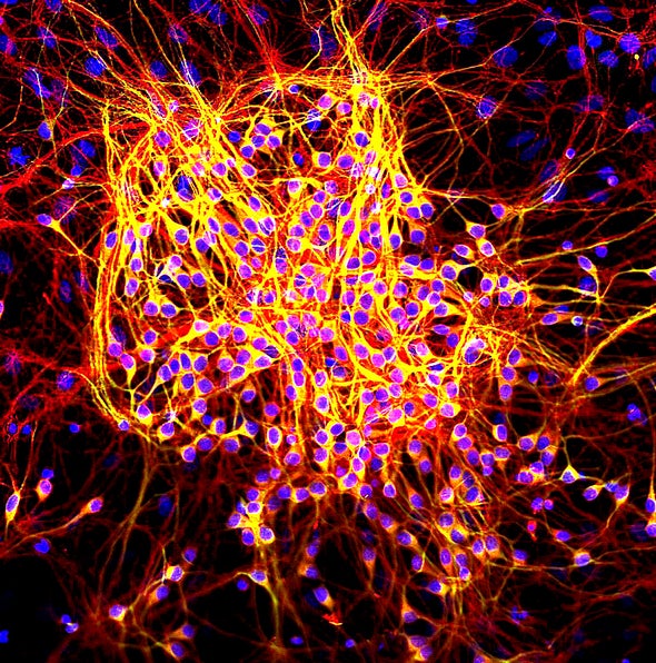 Científicos de Harvard investigan las tau, las otras proteínas que causan alzhéimer