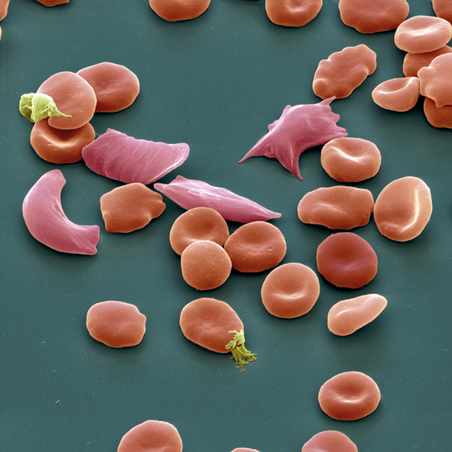 gene-therapy-targets-sickle-cell-disease-scientific-american