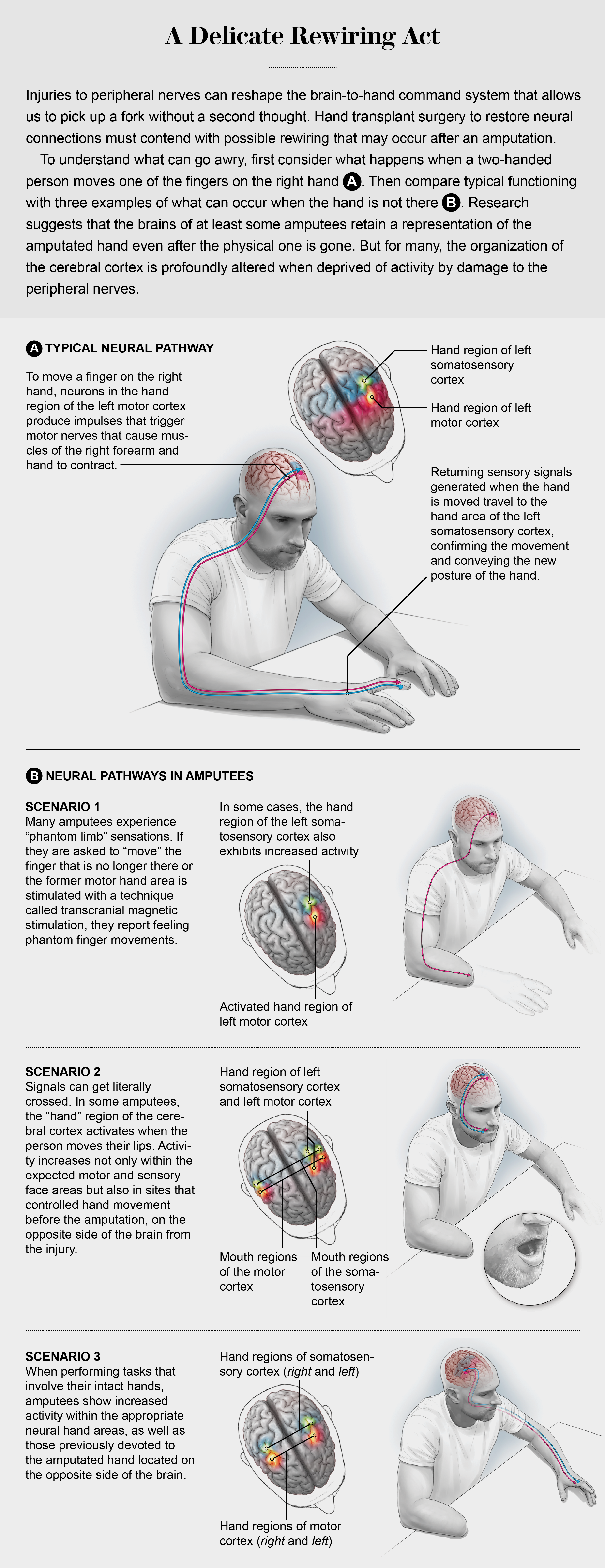 Typical neural pathways and brain regions involved in moving a finger, and 3 altered circuit scenarios that amputees may experience