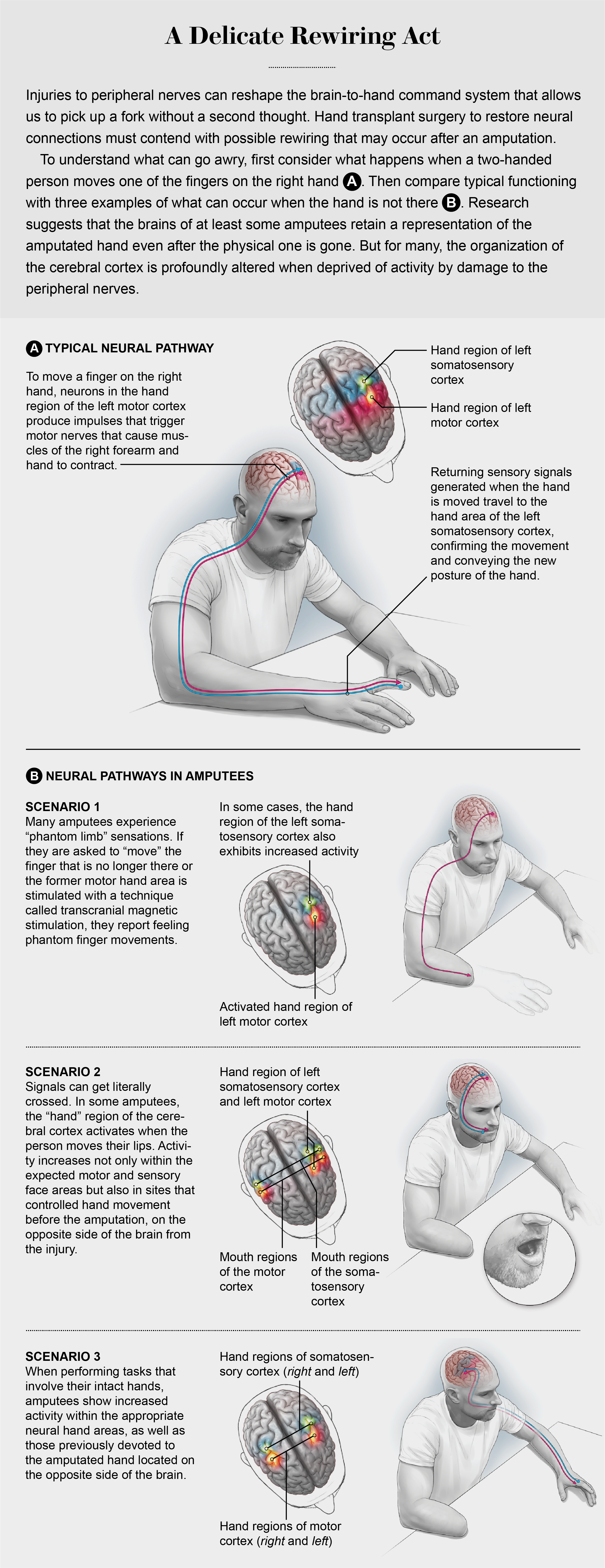 典型的神经通路和大脑区域涉及移动手指，以及截肢者可能经历的3种改变的电路场景