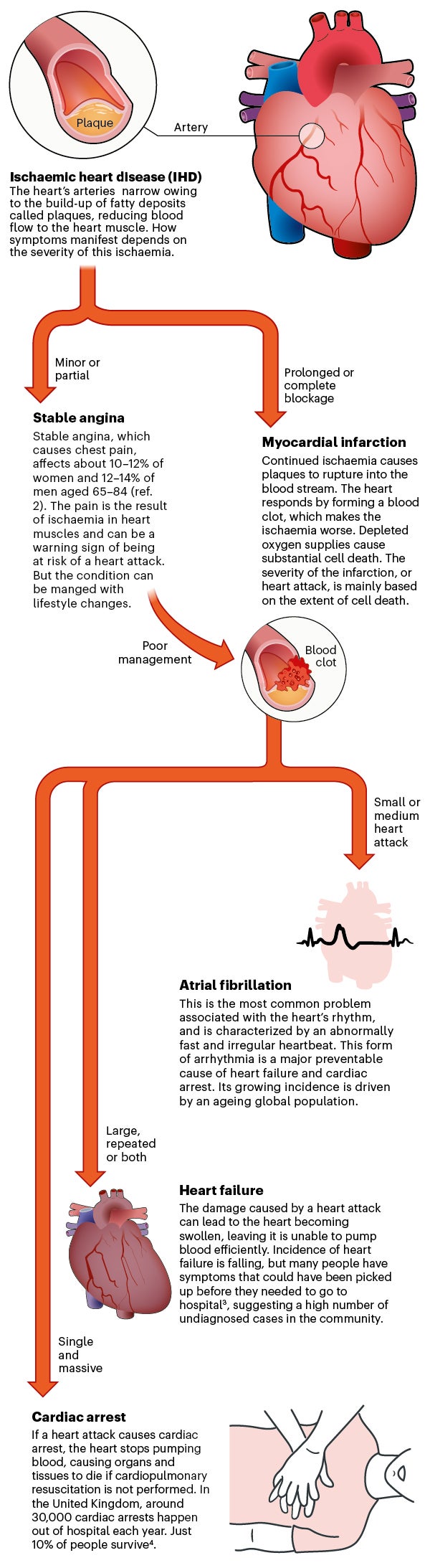 اینفوگرافیک توسعه بیماری ایسکمیک قلب را توصیف می کند.
