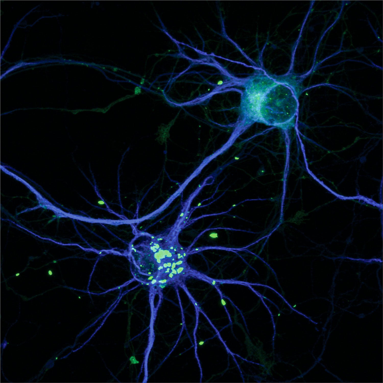 Neural network illustration (blue) with toxic version of the HTT protein, which causes Huntington’s, forming clumps (green).