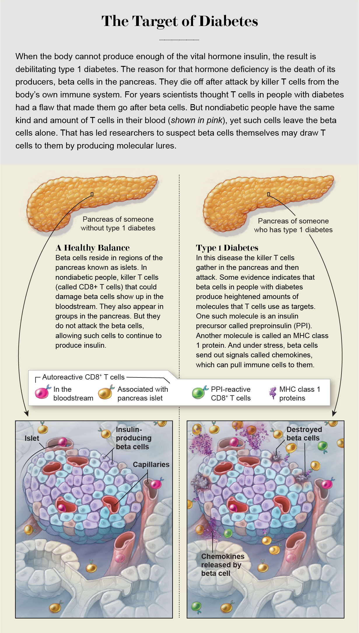 Graphic compares interactions of beta cells and killer T cells in pancreases of people with and without type 1 diabetes.