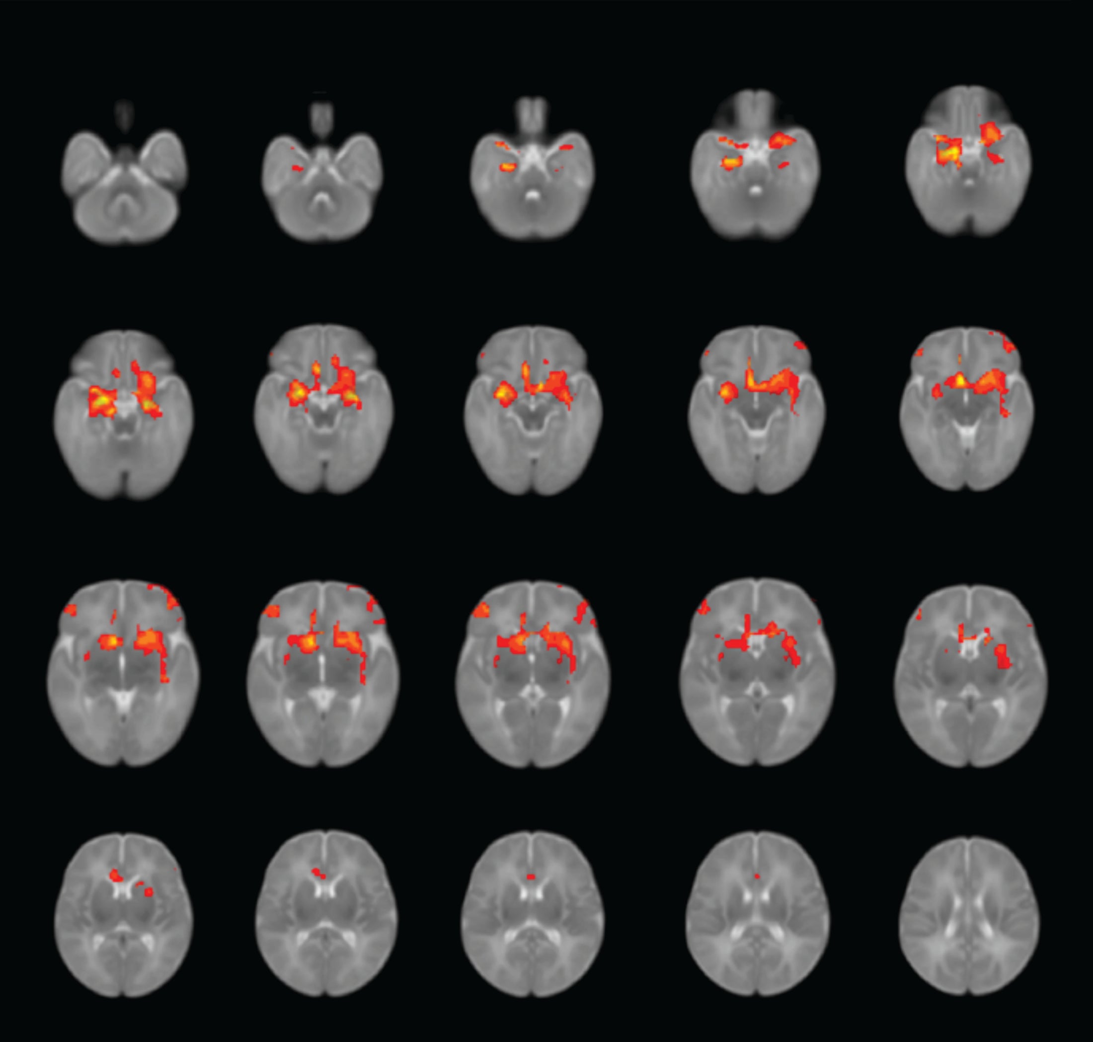 Brain scans showing average connectivity patterns between the amygdala and other regions in infants.
