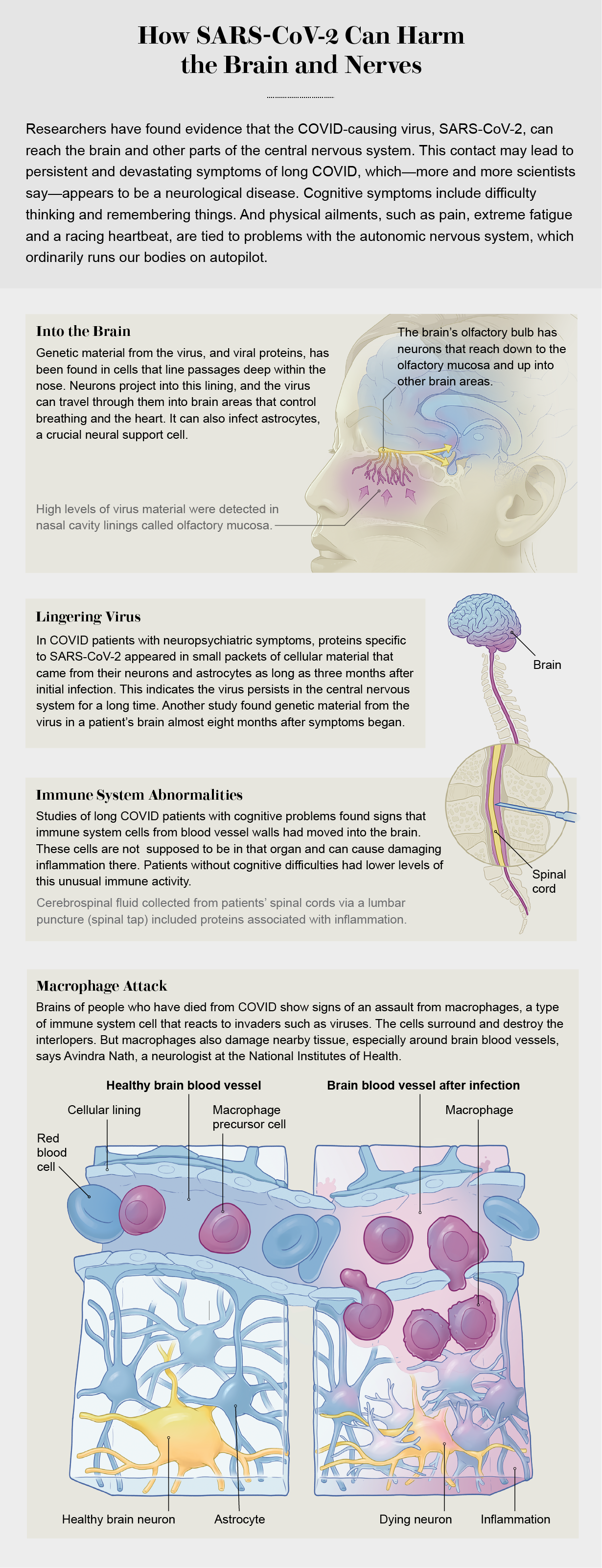 Graphic highlights various ways SARS-CoV-2 can affect the brain and nerves, either by accessing and lingering in nervous system tissues or by stimulating the immune system to react in ways that damage the brain.