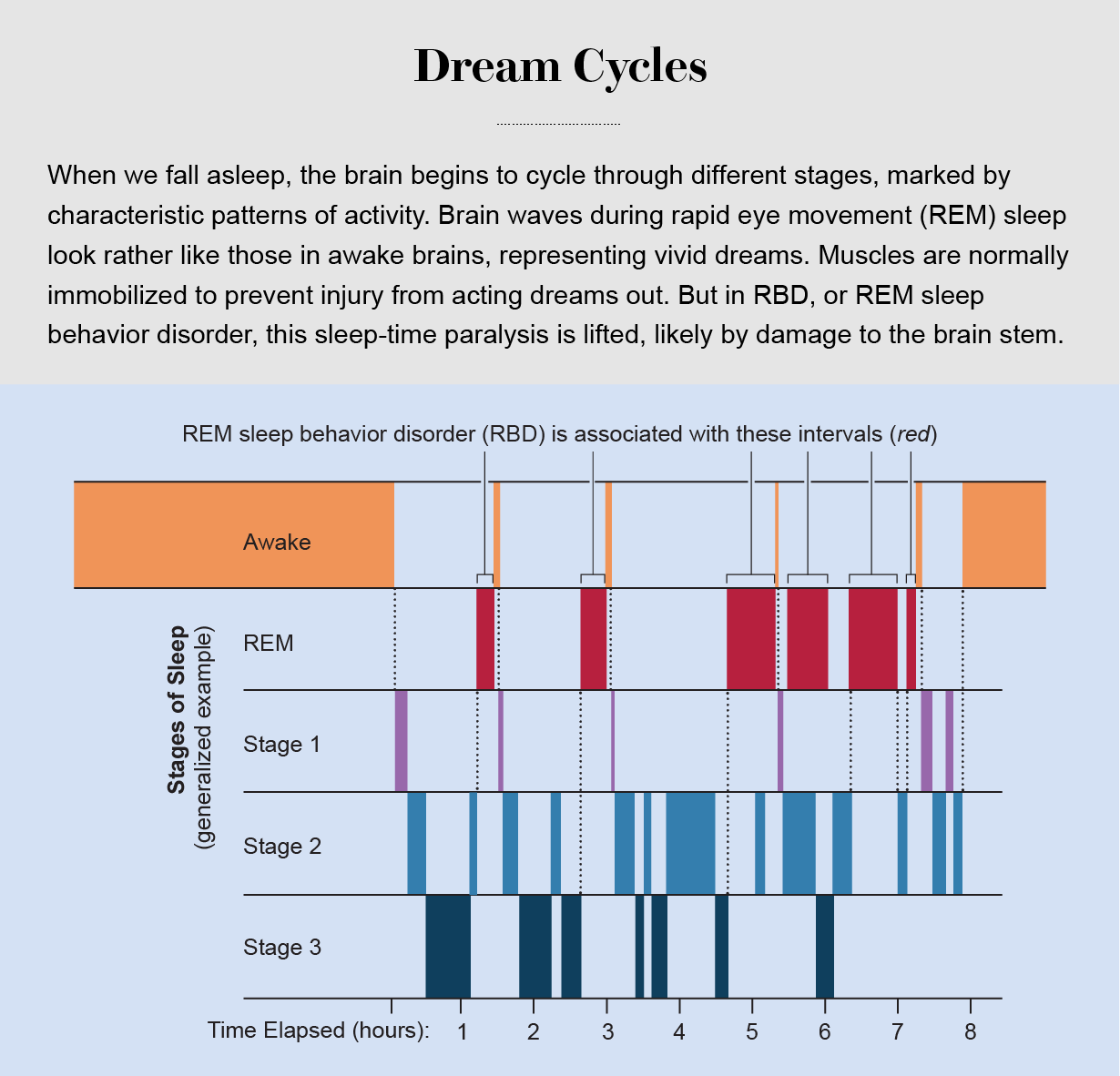 Graphic shows stages of sleep and when episodes of REM sleep behavior disorder typically occur.