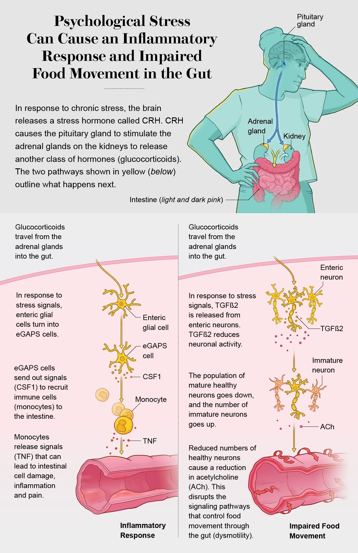 Graphic shows how the release of a stress hormone from the brain can trigger IBD symptoms via two pathways in the gut, one leading to an inflammatory response and the other to impaired food movement.