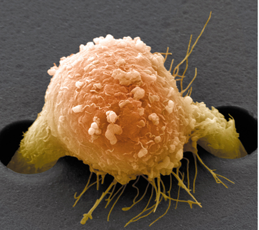 breast cancer cells