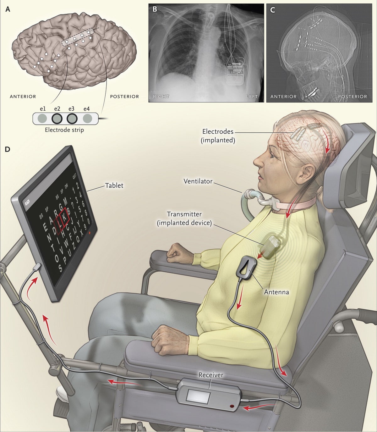 Wireless Brain Implant Allows 