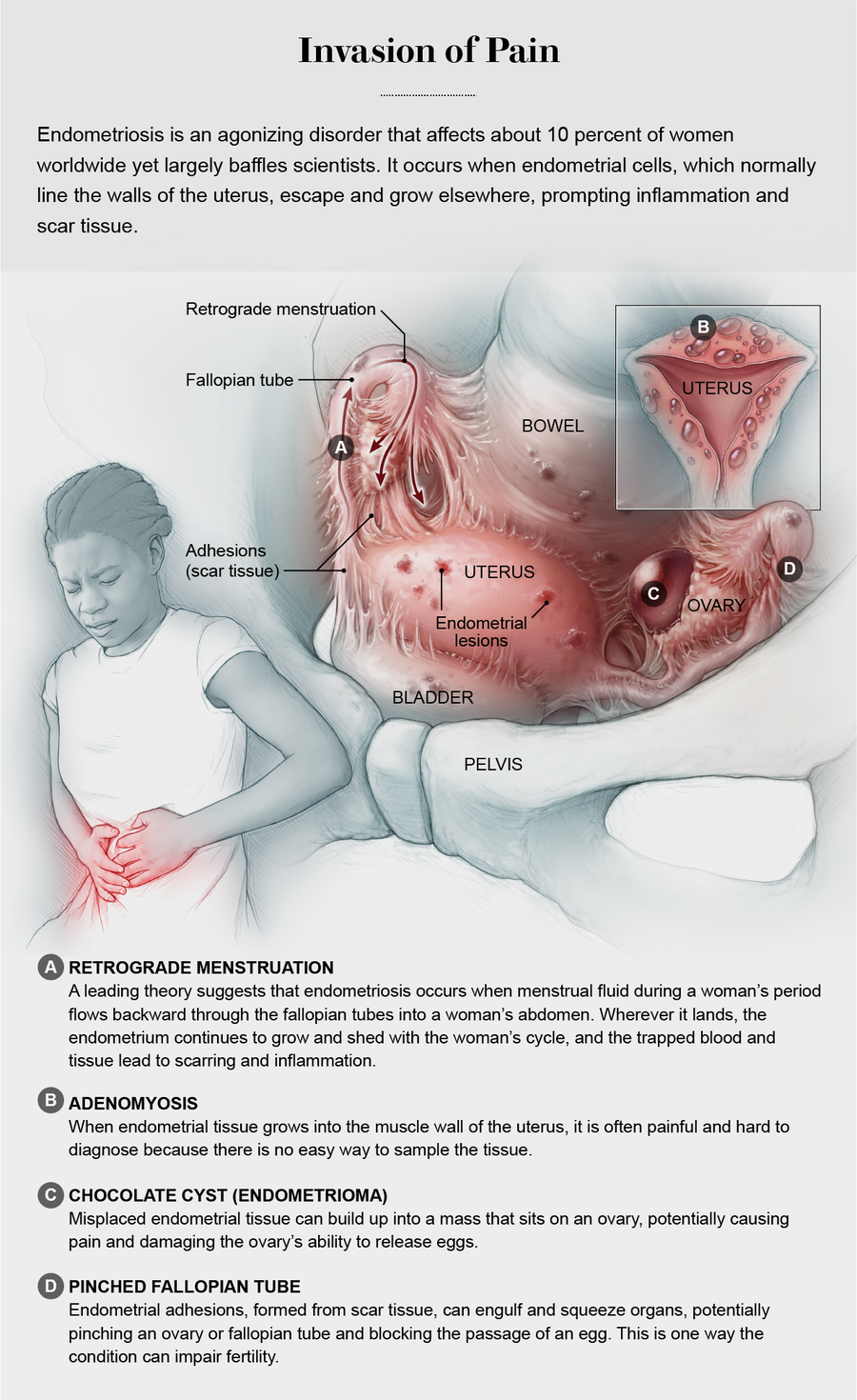 Endometriosis happens when tissue similar to the lining of the uterus  (womb) grows outside of the uterus. Symptoms of endometriosis…