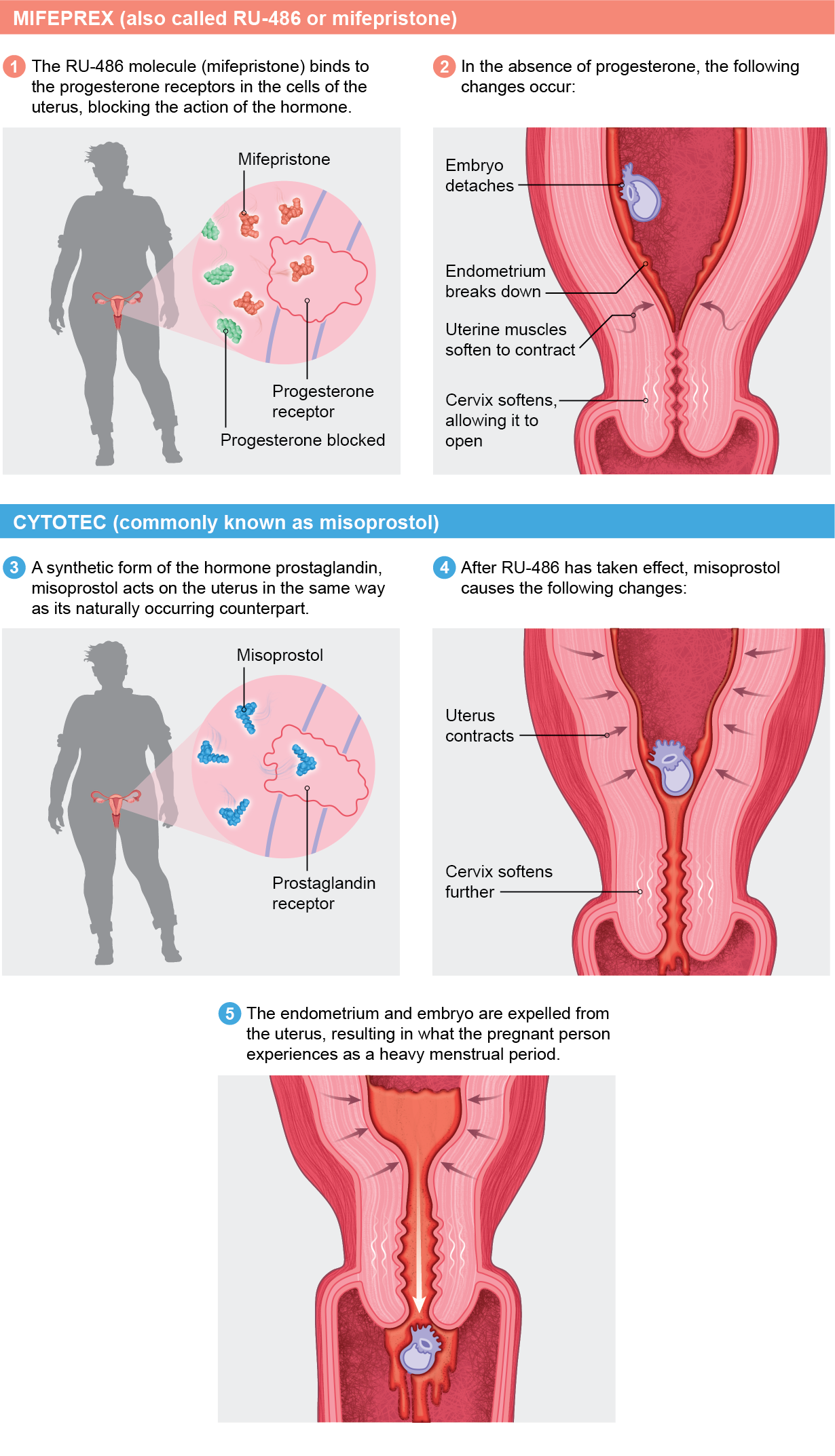 Graphic shows how mifepristone and misoprostol act on the uterus and cervix to expel the embryo and endometrium.
