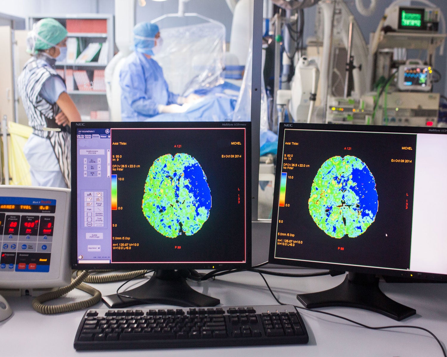 Thrombectomy performed under cerebral angiography on a patient with symptoms of a stroke