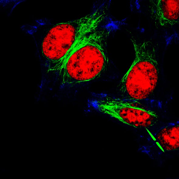 Illuminate and Eliminate: A New Path to Stopping Ovarian Cancer
